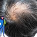 A Question of Coverage: Lee’s Hair-Loss Proposal and the Limits of Public Insurance